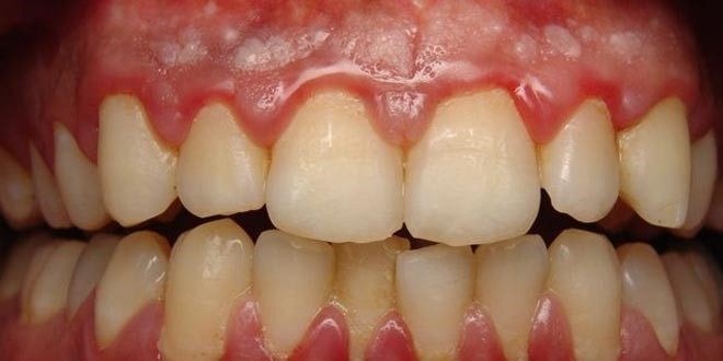 Mas, afinal, o que acontece se você parar de escovar os dentes?