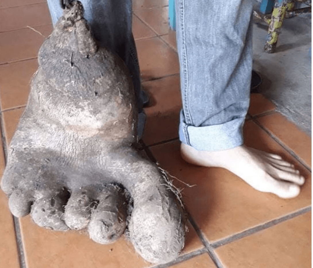 Batata gigante com formato de pé desperta atenção da mídia internacional