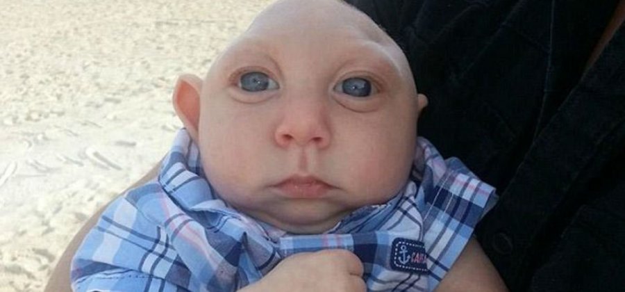Bebê que nasceu sem parte do cérebro completa 4 anos de idade