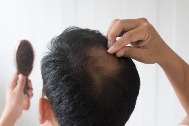 Transplante de cabelo pode ser a solução para os carecas