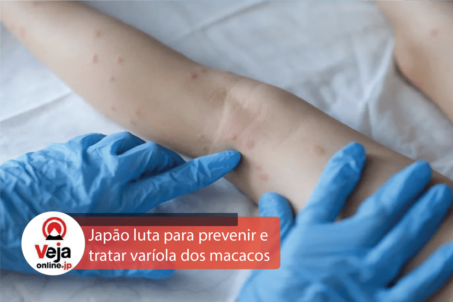 Japão se esforça para prevenir e tratar varíola dos macacos