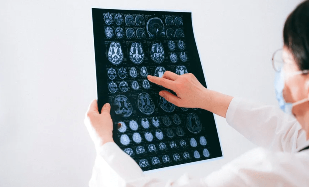 Estudo japonês identifica possível causa da “névoa cerebral” pós-Covid
